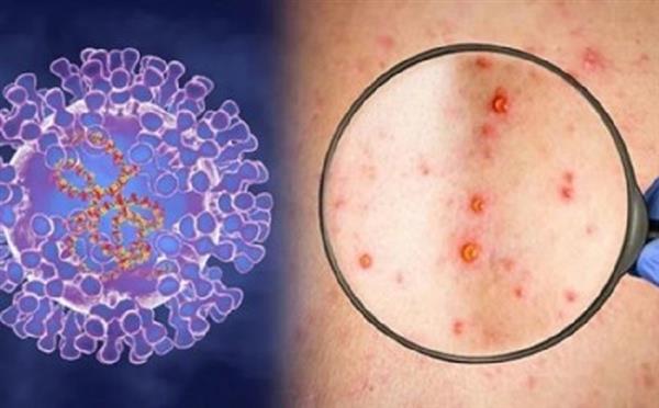 Bệnh đậu mùa khỉ có thể lây từ người sang người khi tiếp xúc gần. Ảnh minh họa. Nguồn: Internet. Bệnh đậu mùa khỉ có thể lây từ người sang người khi tiếp xúc gần. Ảnh minh họa. Nguồn: Internet.